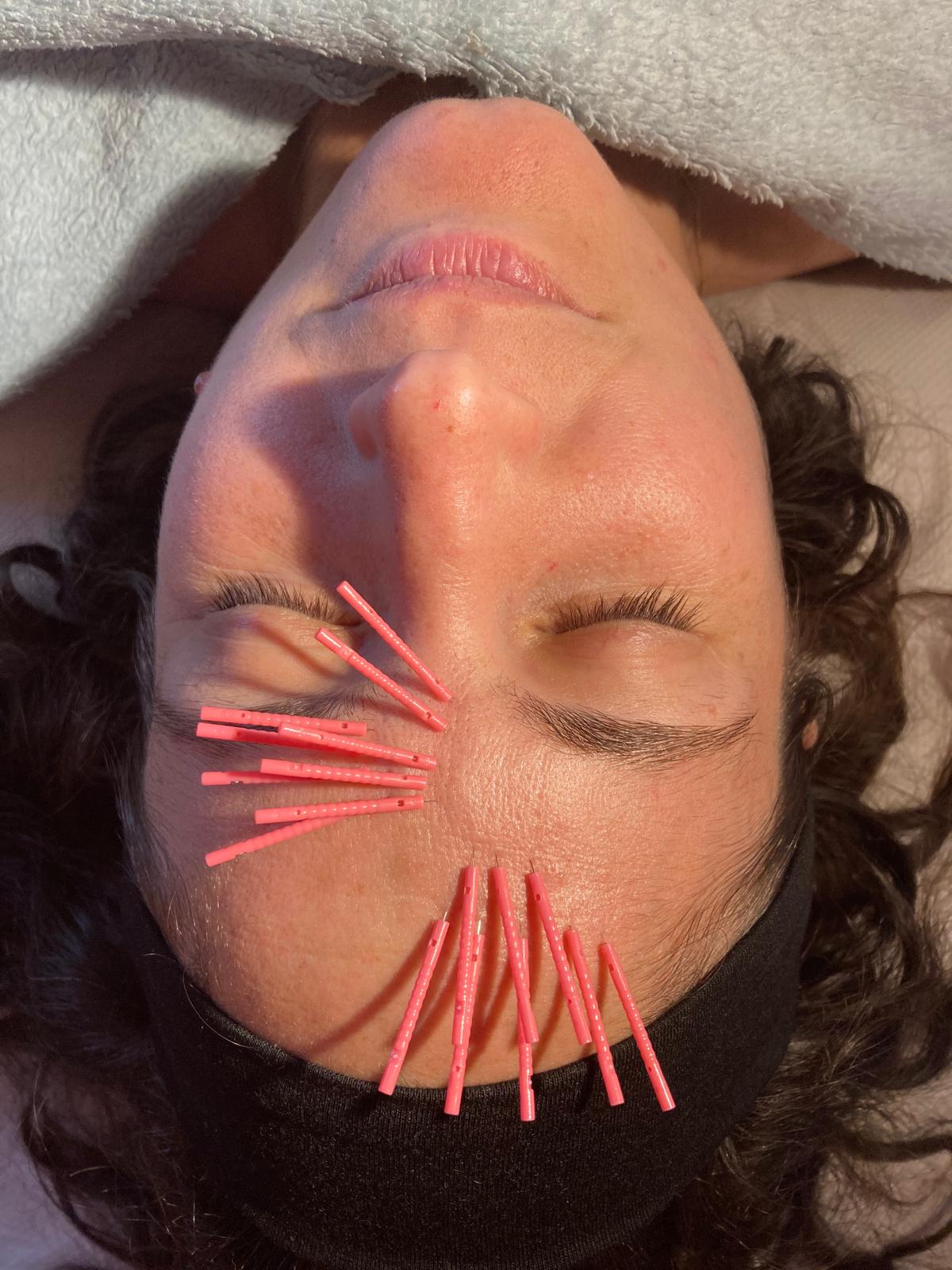 Cosmetic acupuncture treatment with facial needles